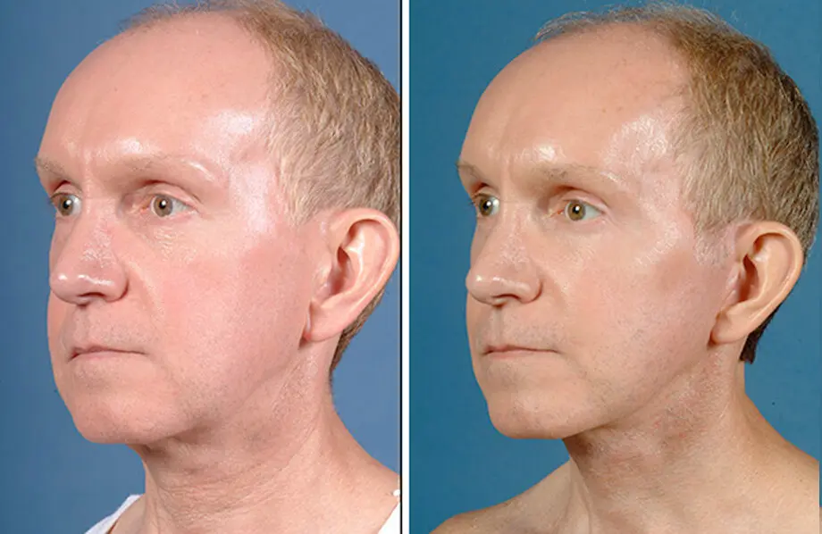 Facelift & Neck Lift Before and After Patient 4