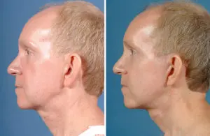 Facelift & Neck Lift Before and After Patient Thumbnail 1