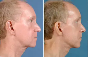 Facelift & Neck Lift Before and After Patient Thumbnail 2