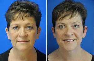 Facelift & Neck Lift Before and After Patient Thumbnail 2