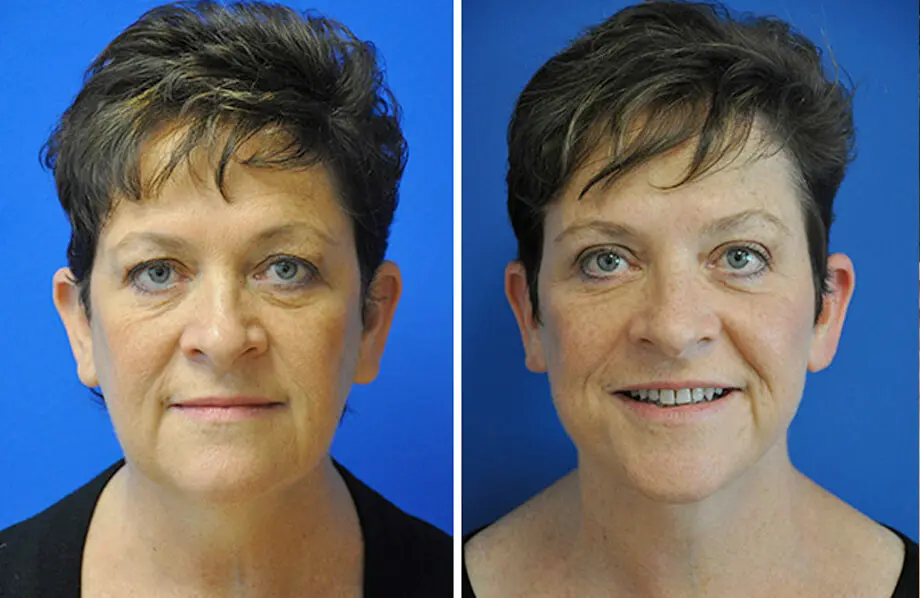 Facelift & Neck Lift Before and After Patient 2