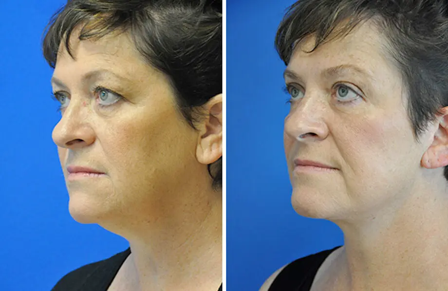 Facelift & Neck Lift Before and After Patient 3