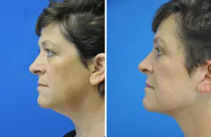 Facelift & Neck Lift Before and After Patient Thumbnail 1