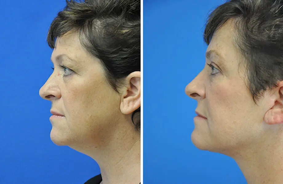 Facelift & Neck Lift Before and After Patient 1