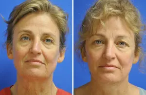 Facelift & Neck Lift Before and After Patient Thumbnail 2