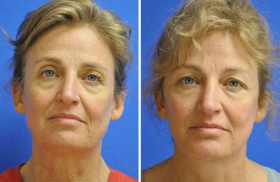 Facelift & Neck Lift Before and After Patient 2