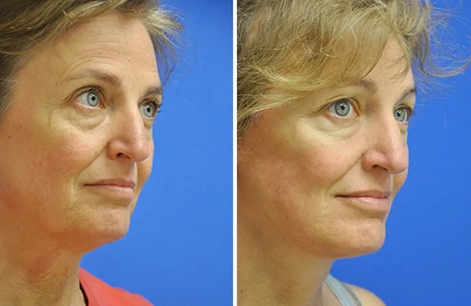 Facelift & Neck Lift Before and After Patient 3