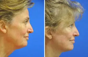 Facelift & Neck Lift Before and After Patient Thumbnail 1