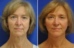 Facelift & Neck Lift Before and After Patient Thumbnail 2