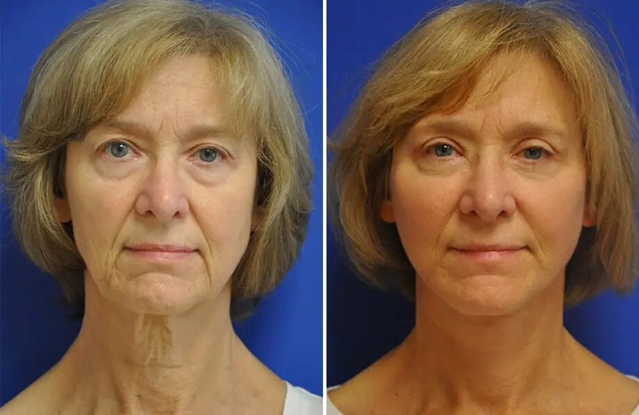 Facelift & Neck Lift Before and After Patient 2