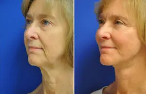 Facelift & Neck Lift Before and After Patient Thumbnail 3