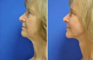 Facelift & Neck Lift Before and After Patient Thumbnail 1