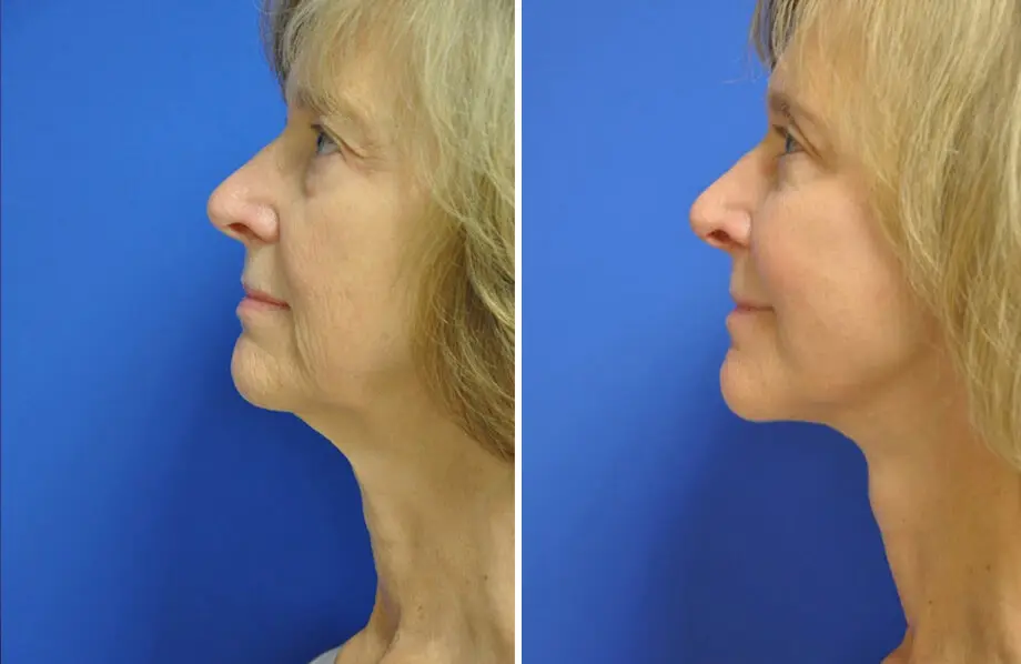 Facelift & Neck Lift Before and After Patient 1