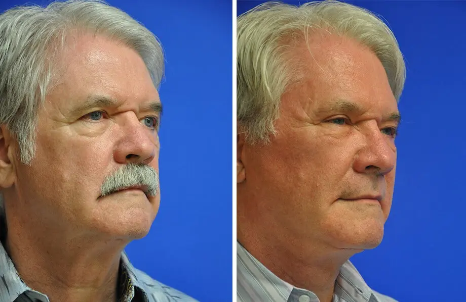Facelift & Neck Lift Before and After Patient 3