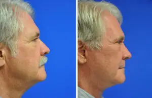 Facelift & Neck Lift Before and After Patient Thumbnail 1