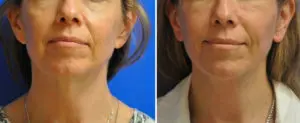 Facelift & Neck Lift Before and After Patient Thumbnail 2