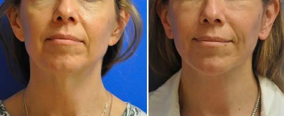 Facelift & Neck Lift Before and After Patient 2