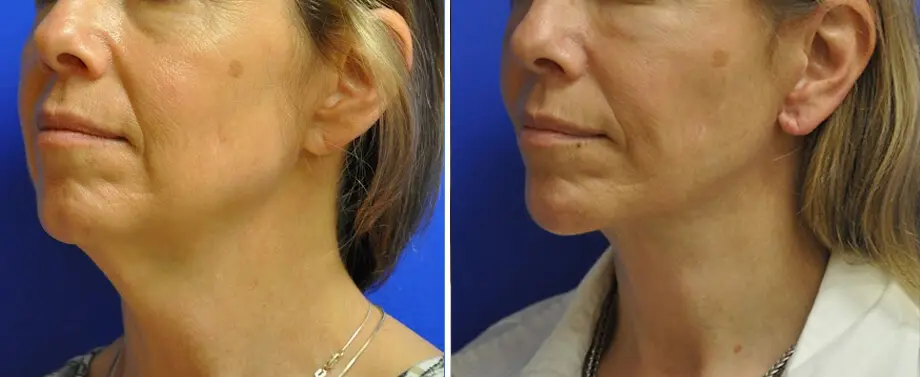 Facelift & Neck Lift Before and After Patient 3