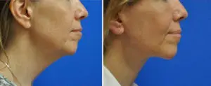 Facelift & Neck Lift Before and After Patient Thumbnail 1
