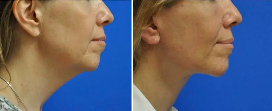 Facelift & Neck Lift Before and After Patient 1