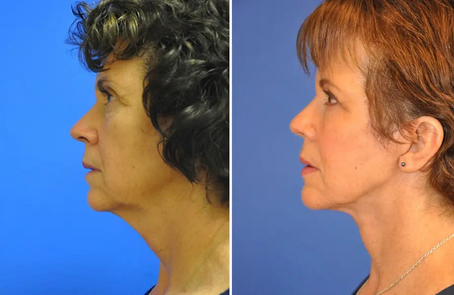 Facelift & Neck Lift Before and After Patient 1