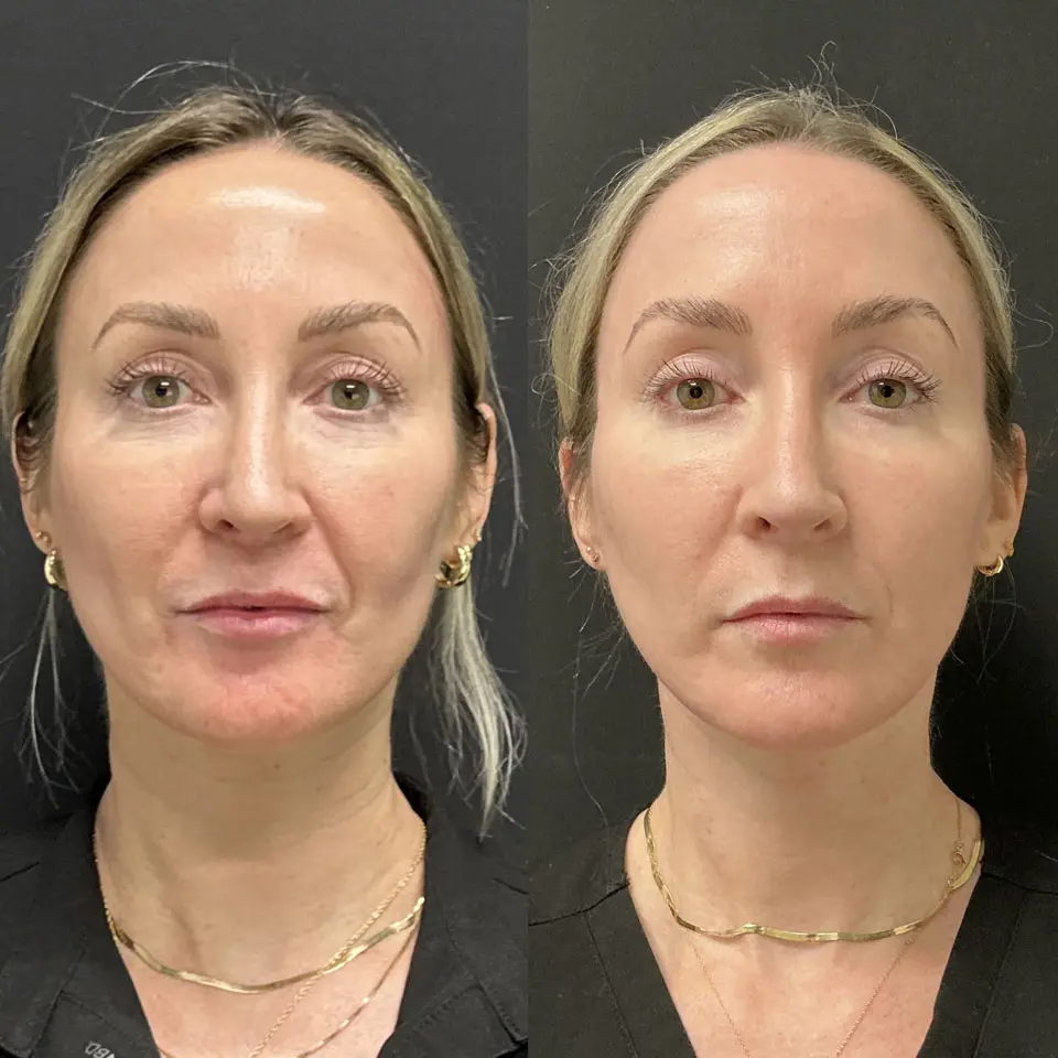 Eyelid Lift Before and After Patient 1