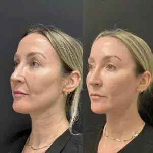 Eyelid Lift Before and After Patient Thumbnail 2