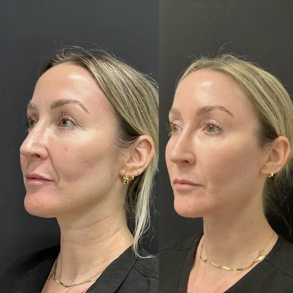 Eyelid Lift Before and After Patient 2