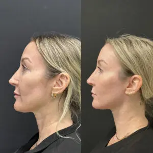Eyelid Lift Before and After Patient Thumbnail 5