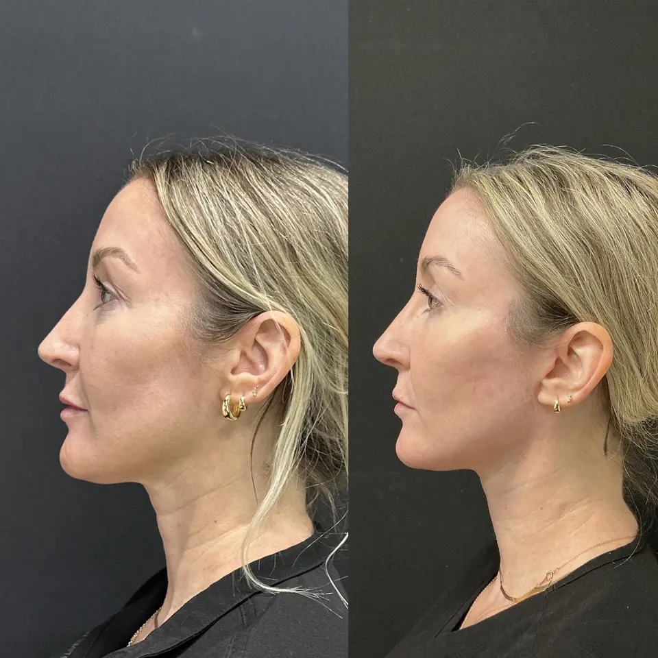 Eyelid Lift Before and After Patient 5