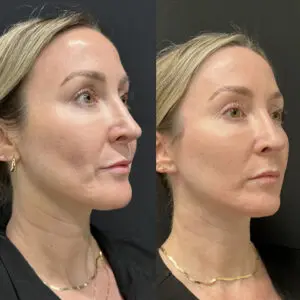 Eyelid Lift Before and After Patient Thumbnail 3