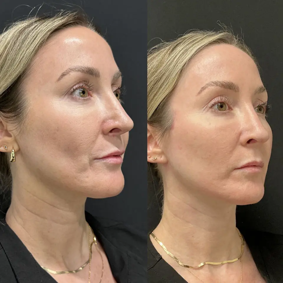Eyelid Lift Before and After Patient 3
