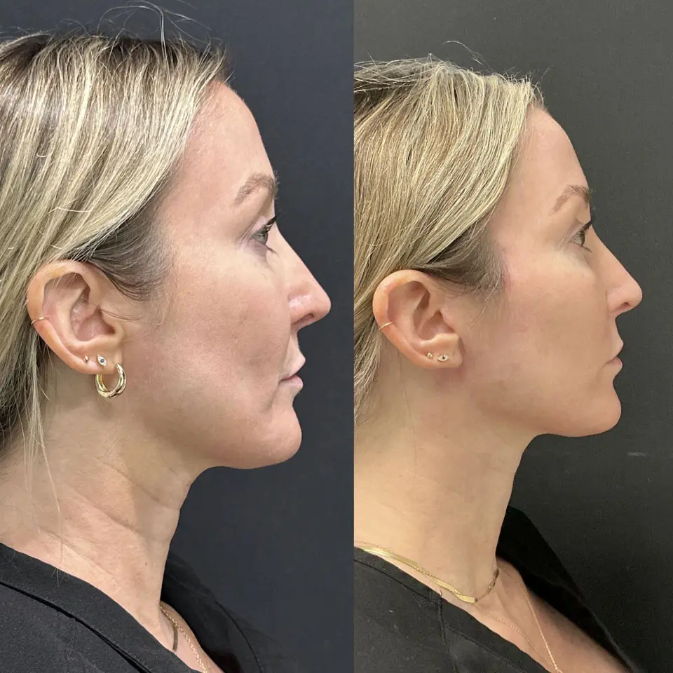 Eyelid Lift Before and After Patient 4