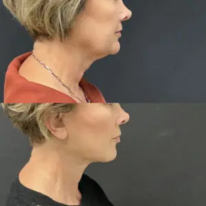 Facial Fat Grafting Before and After Patient Thumbnail 5