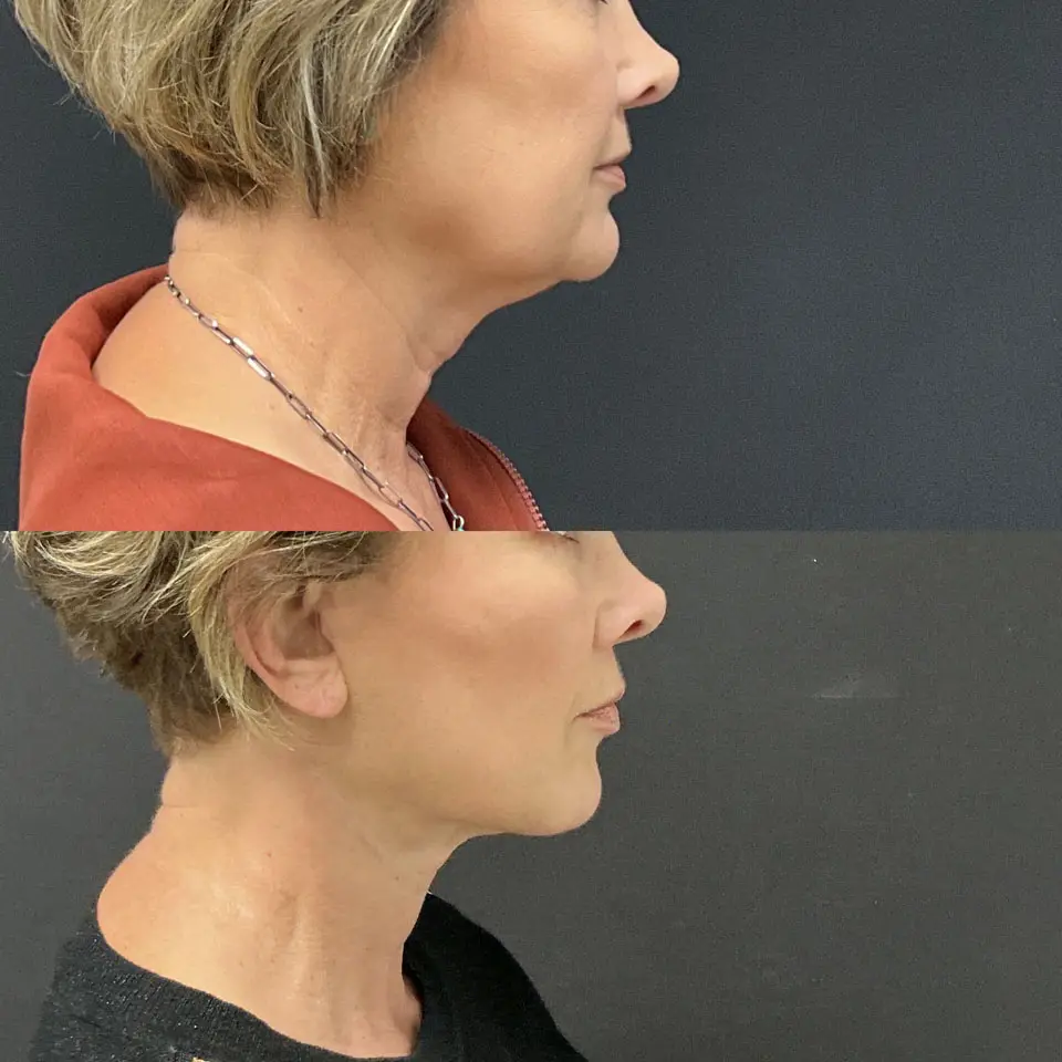 Facial Fat Grafting Before and After Patient 5