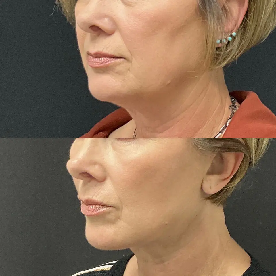 Facial Fat Grafting Before and After Patient 3