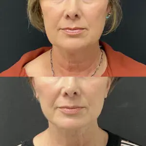 Facial Fat Grafting Before and After Patient Thumbnail 1