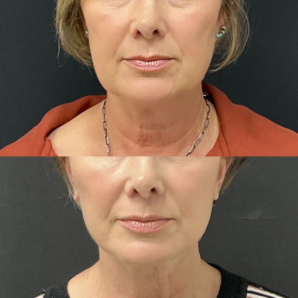 Facial Fat Grafting Before and After Patient 1