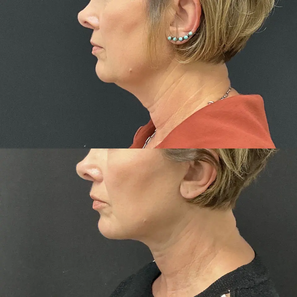Facial Fat Grafting Before and After Patient 4