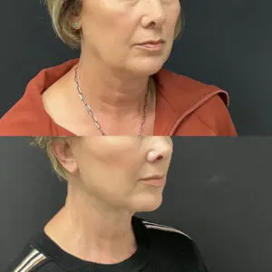 Facial Fat Grafting Before and After Patient Thumbnail 2