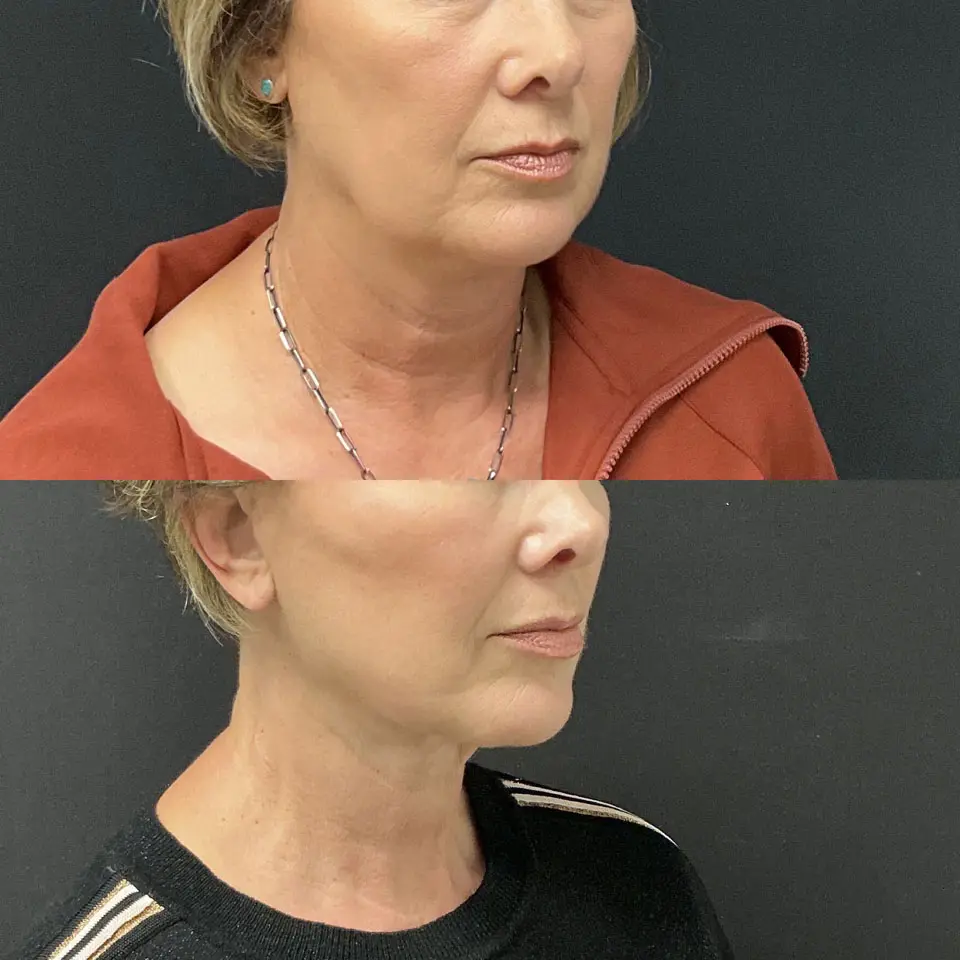 Facial Fat Grafting Before and After Patient 2