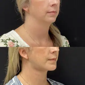 Facelift & Neck Lift Before and After Patient Thumbnail 3