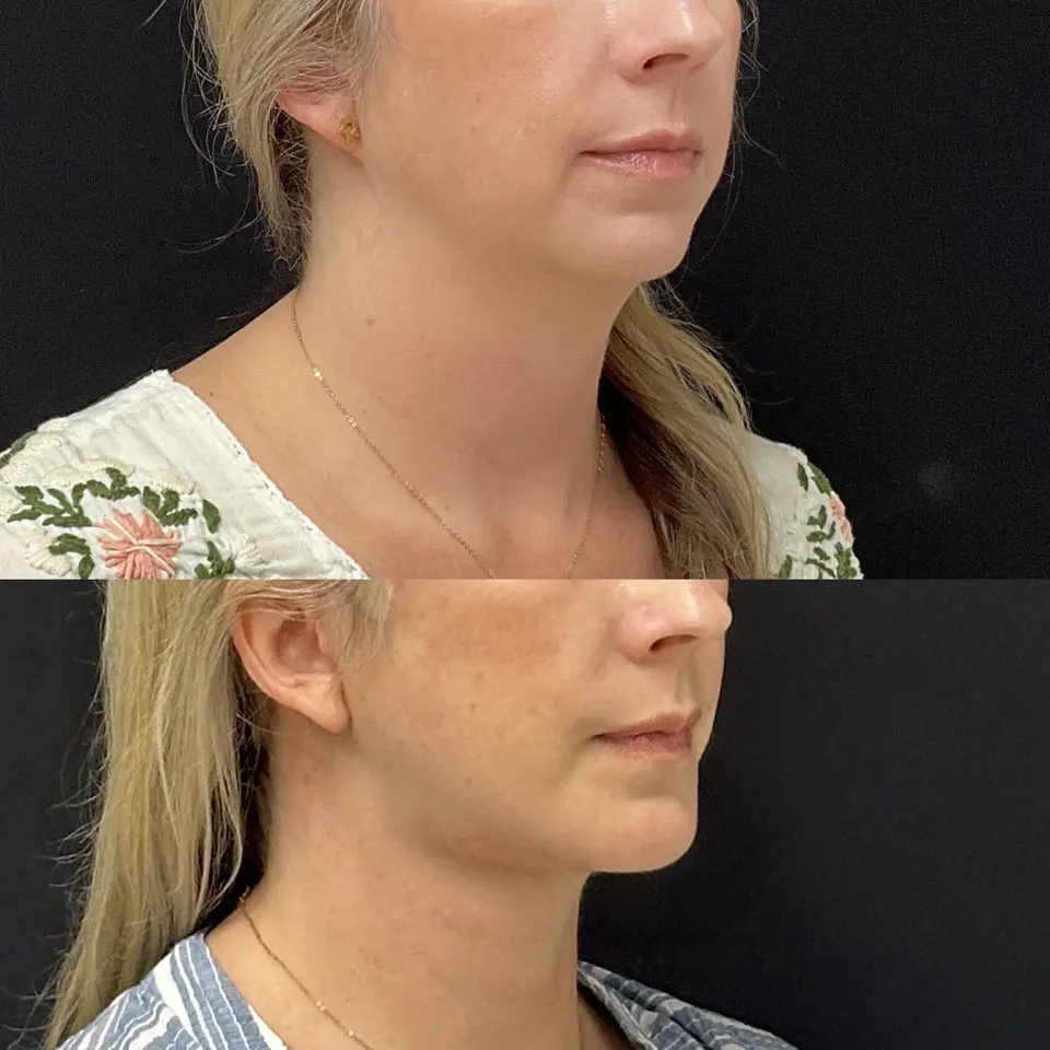 Facelift & Neck Lift Before and After Patient 3