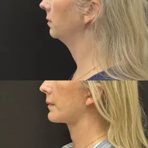 Facelift & Neck Lift Before and After Patient Thumbnail 2