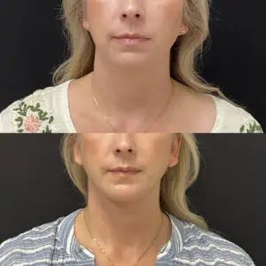 Facelift & Neck Lift Before and After Patient Thumbnail 1