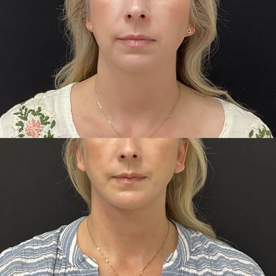 Facelift & Neck Lift Before and After Patient 1