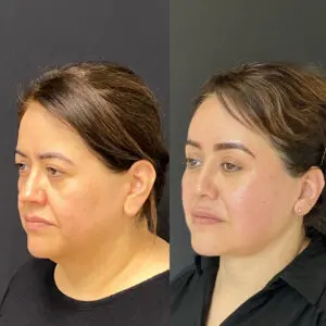 Eyelid Lift Before and After Patient Thumbnail 3