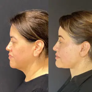Eyelid Lift Before and After Patient Thumbnail 5