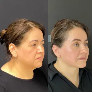Eyelid Lift Before and After Patient Thumbnail 2