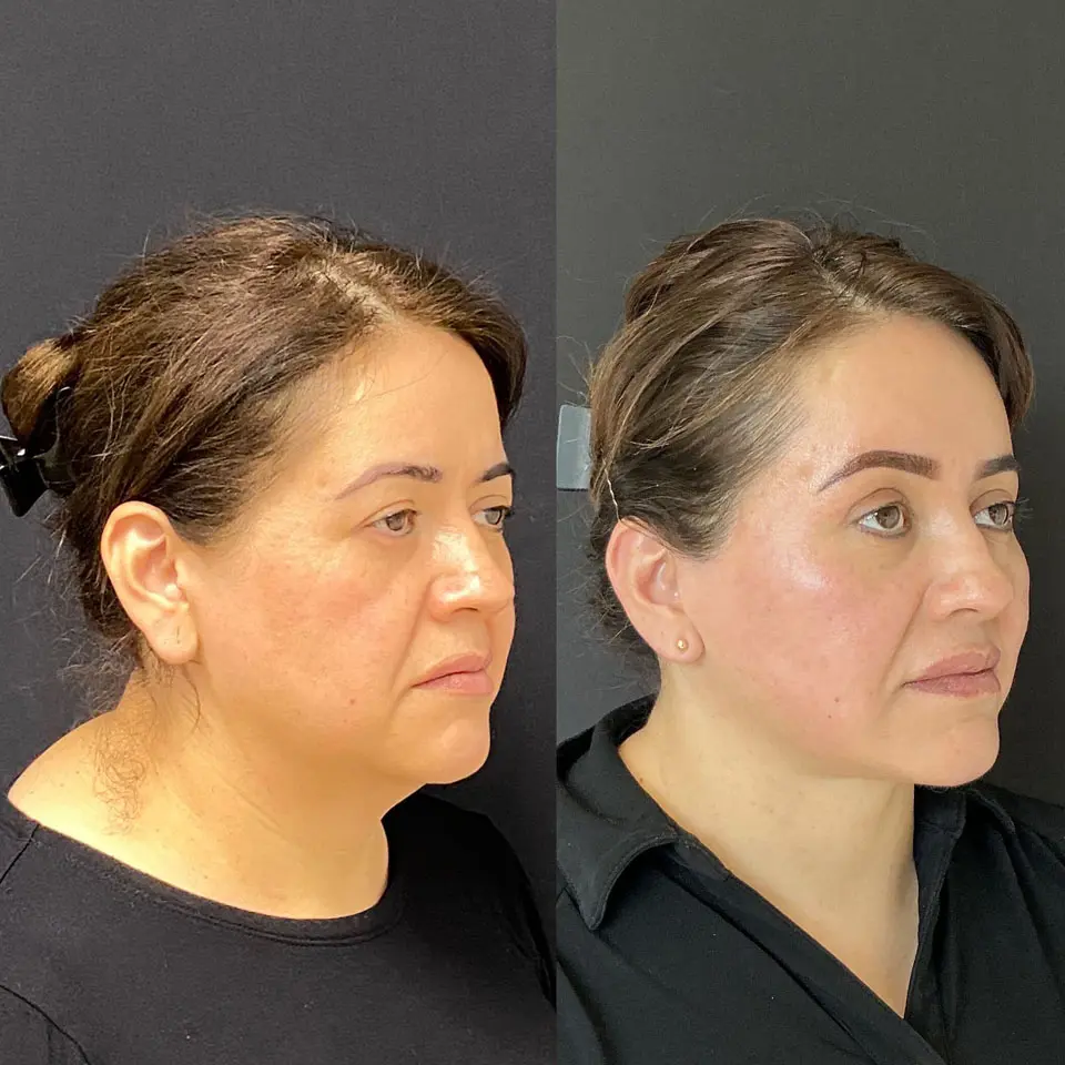 Eyelid Lift Before and After Patient 2